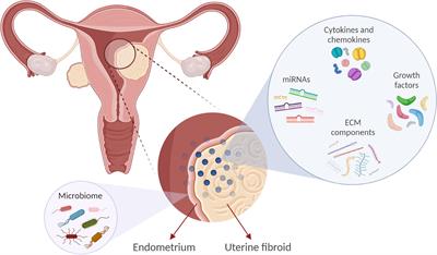 uterine fibroids research papers